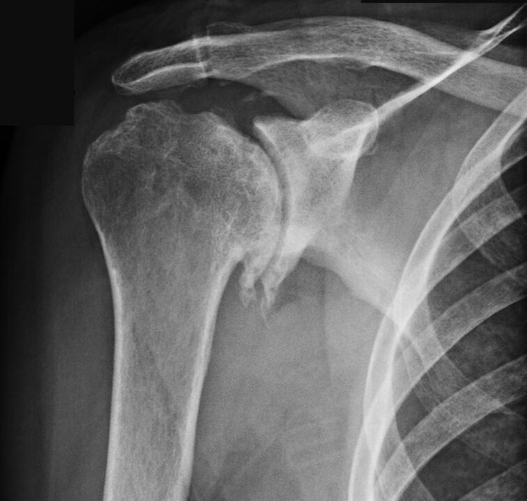 La radiographie a montré une arthrose de l'épaule