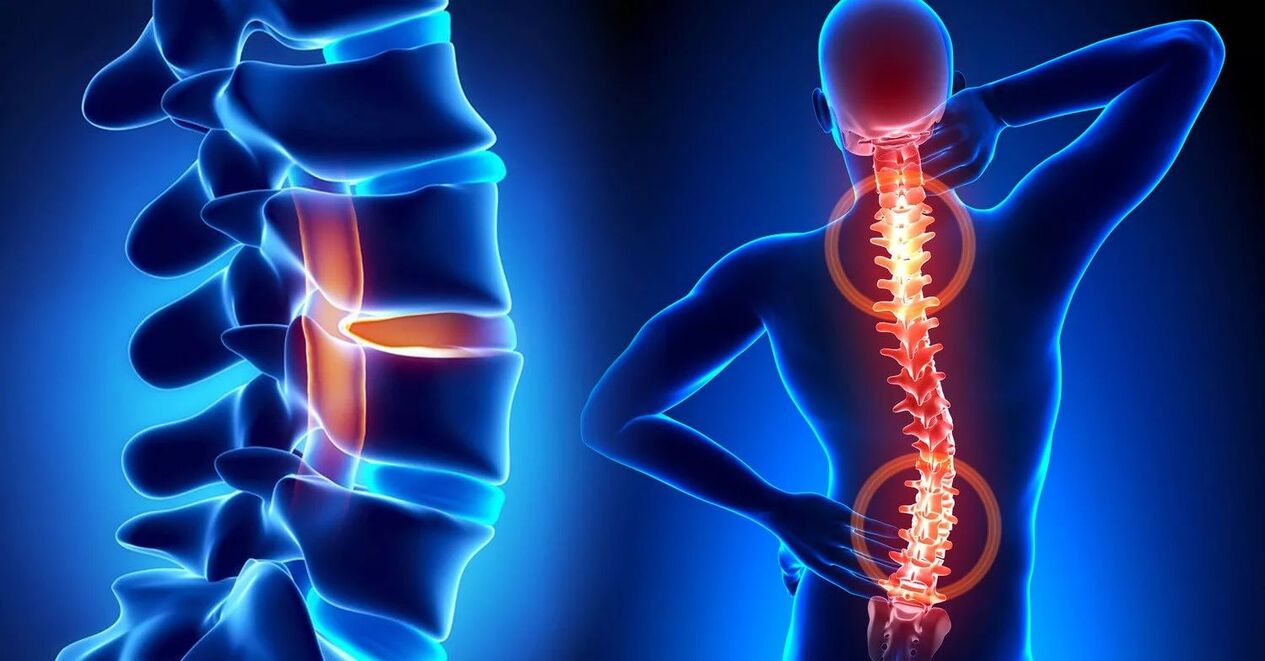 complications de l'ostéochondrose cervicale