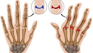Les principales différences d'arthrite et d'arthrose