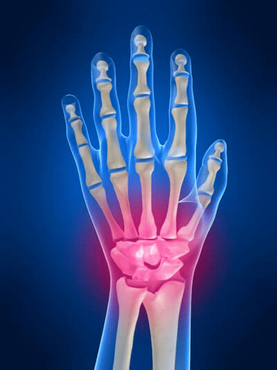 Arthrite de l'articulation du poignet