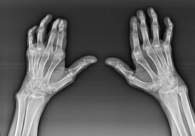 Diagnostics des articulations des doigts