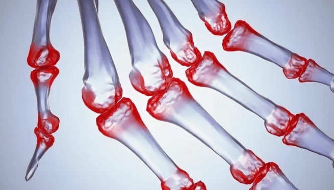 Douleur dans les articulations des doigts