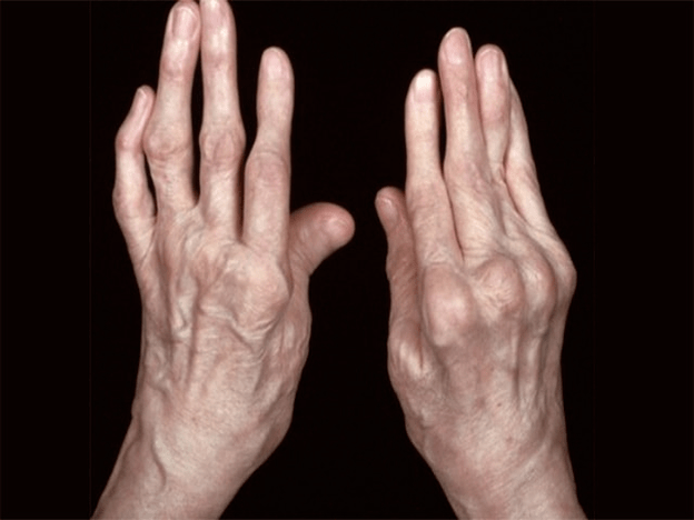 arthrite comme cause de douleur dans les articulations des doigts