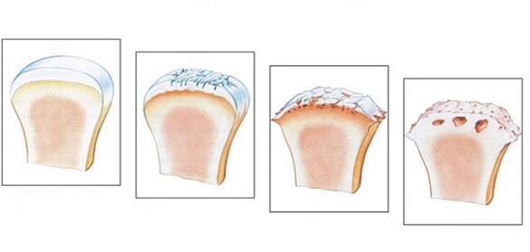 Articulation saine et 3 degrés de développement de l'arthrose