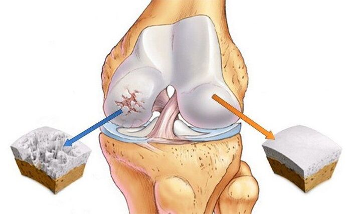 Articulations saines et arthrosées