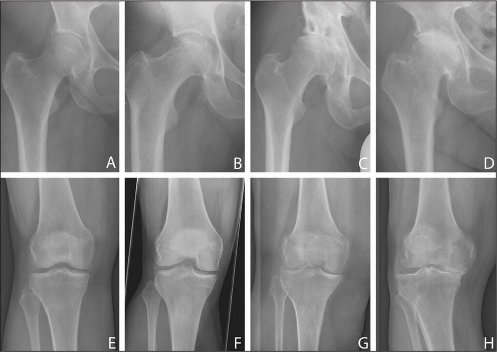 Stades de développement de l'arthrose articulaire sur une radiographie