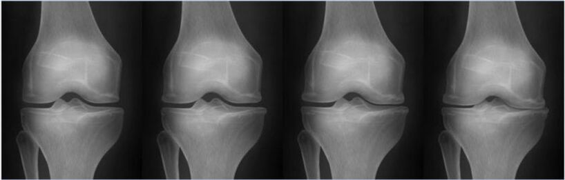 Stades de l'arthrose selon la classification de Kellgren-Lawrence