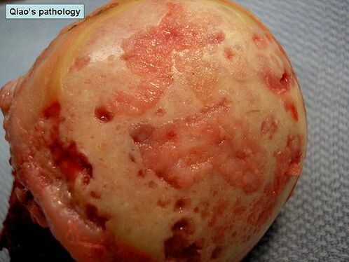 Surface cartilagineuse affectée par l'arthrose